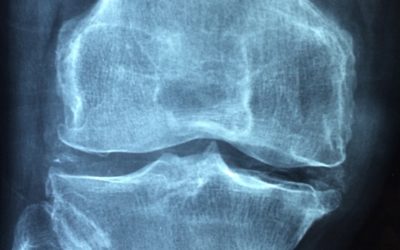 Quelques recommandations pour prévenir l’ostéoporose